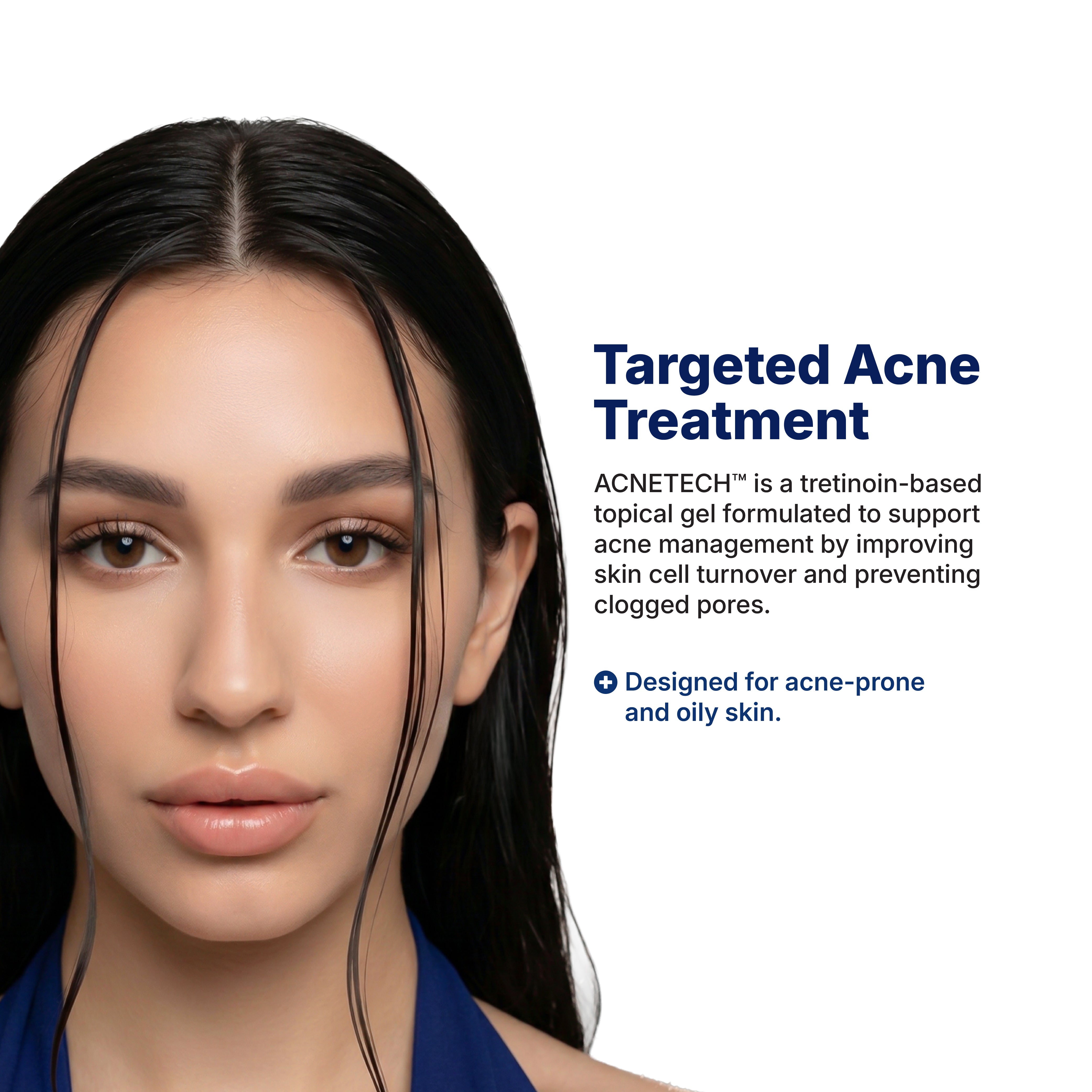 After — clearer, smoother skin after 84 days of ACNETECH